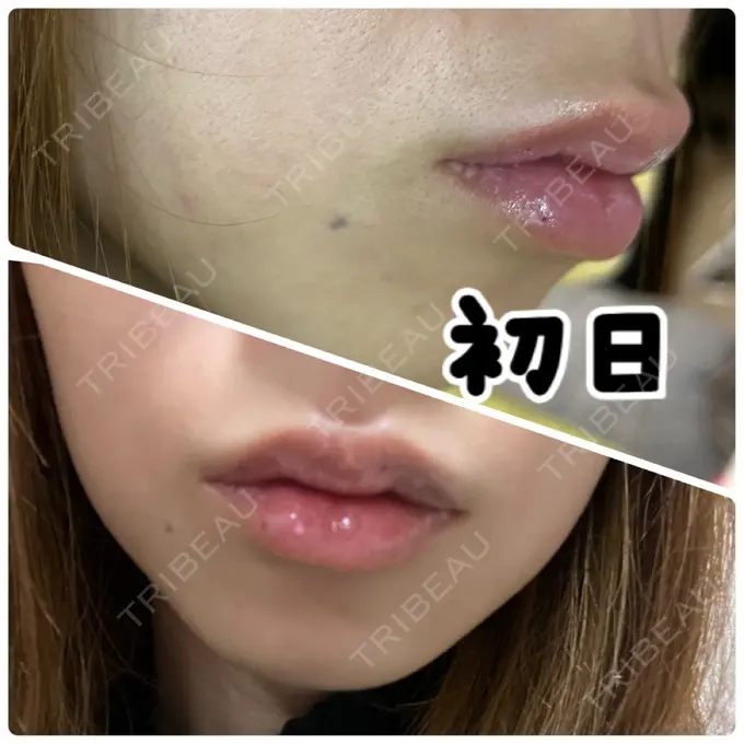 ヒアルロン酸注入（唇） 渋谷美容外科クリニック 新橋院 DAY 0 メイン用