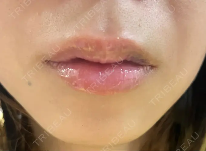 ヒアルロン酸注入（唇） 渋谷美容外科クリニック 新橋院 DAY 2 メイン用