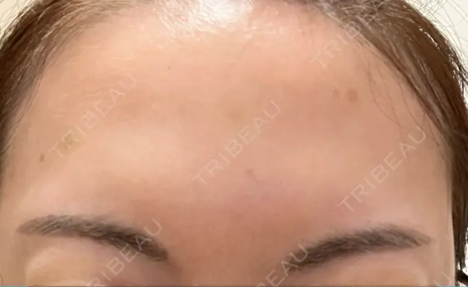 ボトックス（あご） / ボトックス（肩） / ボトックス（眉間） / ボトックス（額） M'sクリニック【エムズクリニック】 DAY 5 メイン用