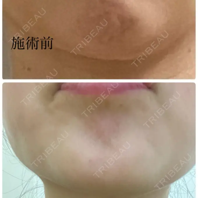 ボトックス（あご） / ボトックス（肩） / ボトックス（眉間） / ボトックス（額） M'sクリニック【エムズクリニック】 DAY 5 メイン用