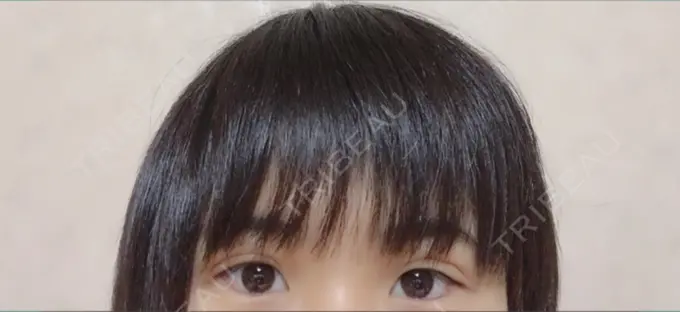 二重埋没 久留米総合美容外科 DAY 1 メイン用