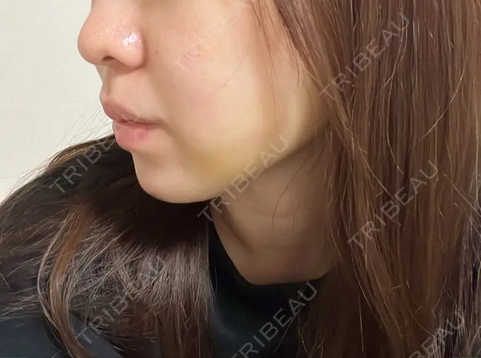 糸リフト / バッカルファット除去 / 脂肪吸引（顔） / ヒアルロン酸注入（あご） / ボトックス（エラ・小顔） RIVER CLINIC（リバークリニック） DAY 5 メイン用