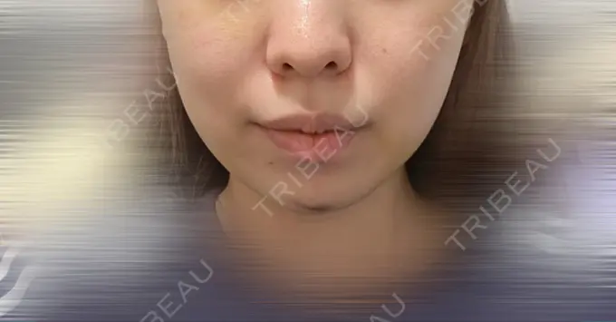 糸リフト / バッカルファット除去 / 脂肪吸引（顔） / ヒアルロン酸注入（あご） / ボトックス（エラ・小顔） RIVER CLINIC（リバークリニック） DAY 5 メイン用