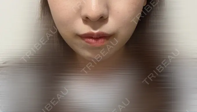 糸リフト / バッカルファット除去 / 脂肪吸引（顔） / ヒアルロン酸注入（あご） / ボトックス（エラ・小顔） RIVER CLINIC（リバークリニック） DAY 7 メイン用