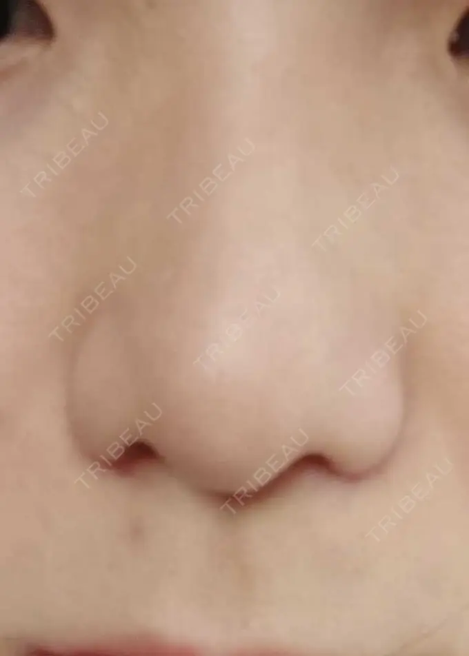 小鼻縮小（切開） 宇都宮ひふ科形成外科 AFTER メイン用