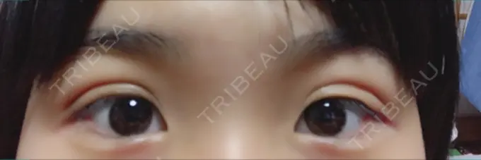 二重埋没 久留米総合美容外科 DAY 1 メイン用