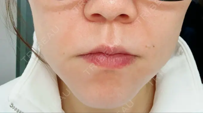 肌ヒアルロン酸注入（たるみ・シワ改善） 豊洲内科・糖尿病 / 形成・美容外科クリニック DAY 0 メイン用