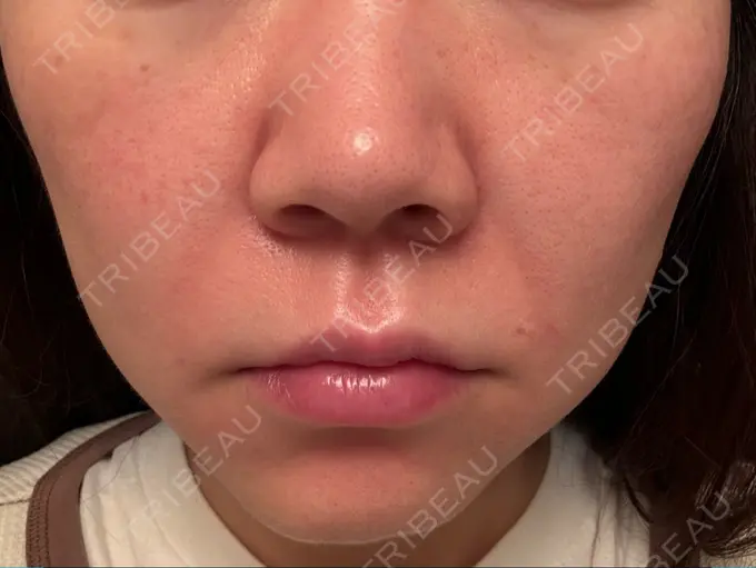 肌ヒアルロン酸注入（たるみ・シワ改善） 豊洲内科・糖尿病 / 形成・美容外科クリニック DAY 1 メイン用