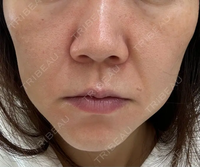 肌ヒアルロン酸注入（たるみ・シワ改善） 豊洲内科・糖尿病 / 形成・美容外科クリニック DAY 5 メイン用