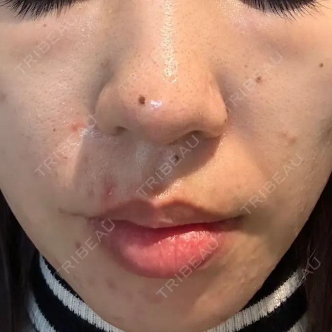 光治療（フォトフェイシャルなど） MKクリニック 日本橋院 DAY 0 メイン用