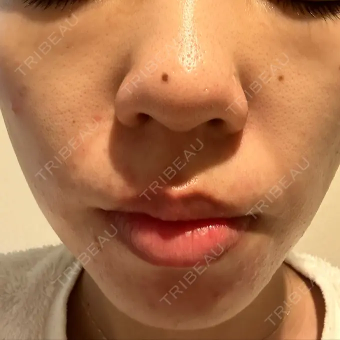 光治療（フォトフェイシャルなど） MKクリニック 日本橋院 AFTER メイン用