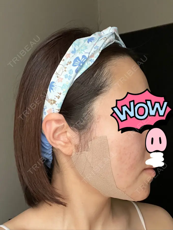 糸リフト / ボトックス（あご） / ヒアルロン酸注入（あご） / ボトックス（エラ・小顔） / ボトックス（口角） / ヒアルロン酸注入（頬） GRACIA clinic 【グラシアクリニック】 DAY 1 メイン用