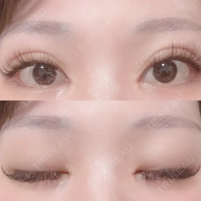 二重埋没 / 目頭切開 Brandnew Beauty Clinic DAY 26 メイン用