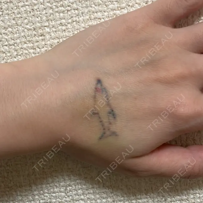 タトゥー除去 ziz CLINIC DAY 4 メイン用