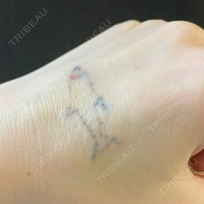 タトゥー除去 ziz CLINIC DAY 4 メイン用