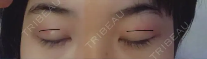 二重埋没 久留米総合美容外科 DAY 2 メイン用