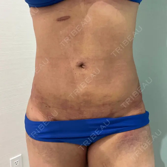 脂肪吸引（お腹） / 脂肪吸引（腰） / 脂肪吸引（背中） WOM CLINIC GINZA （ワム クリニック ギンザ） DAY 7 メイン用