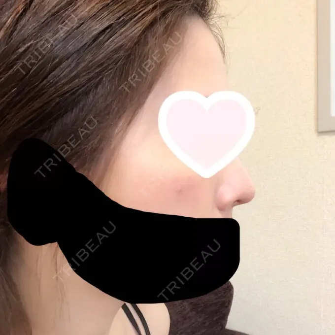 鼻尖形成（切開） / 軟骨移植 グローバルビューティークリニック 大阪院 DAY 32 メイン用