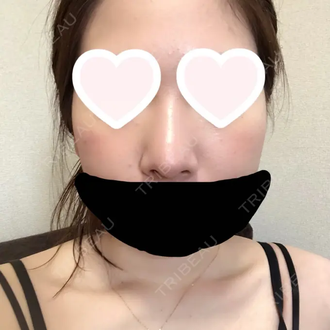 鼻尖形成（切開） / 軟骨移植 グローバルビューティークリニック 大阪院 DAY 32 メイン用