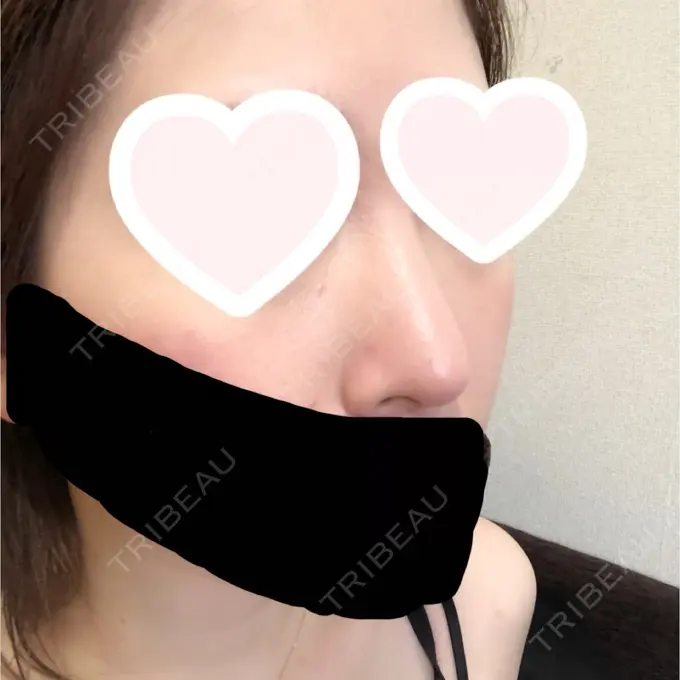 鼻尖形成（切開） / 軟骨移植 グローバルビューティークリニック 大阪院 DAY 32 メイン用