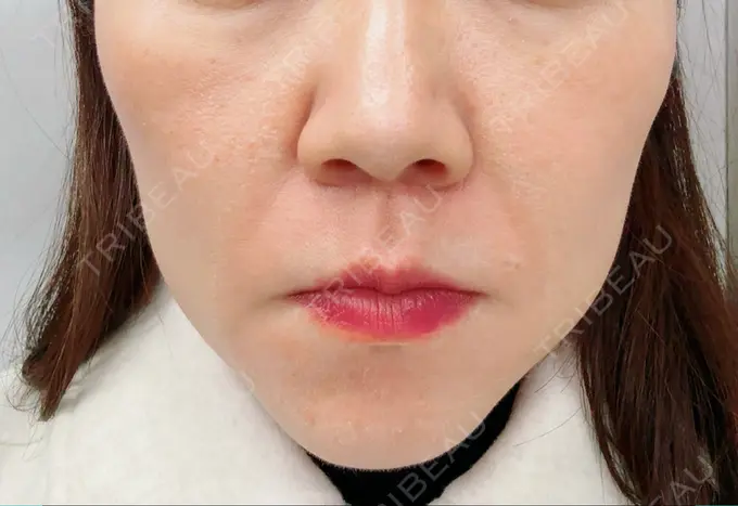 肌ヒアルロン酸注入（たるみ・シワ改善） 豊洲内科・糖尿病 / 形成・美容外科クリニック DAY 6 メイン用