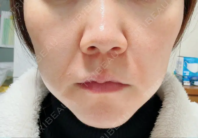 肌ヒアルロン酸注入（たるみ・シワ改善） 豊洲内科・糖尿病 / 形成・美容外科クリニック AFTER メイン用