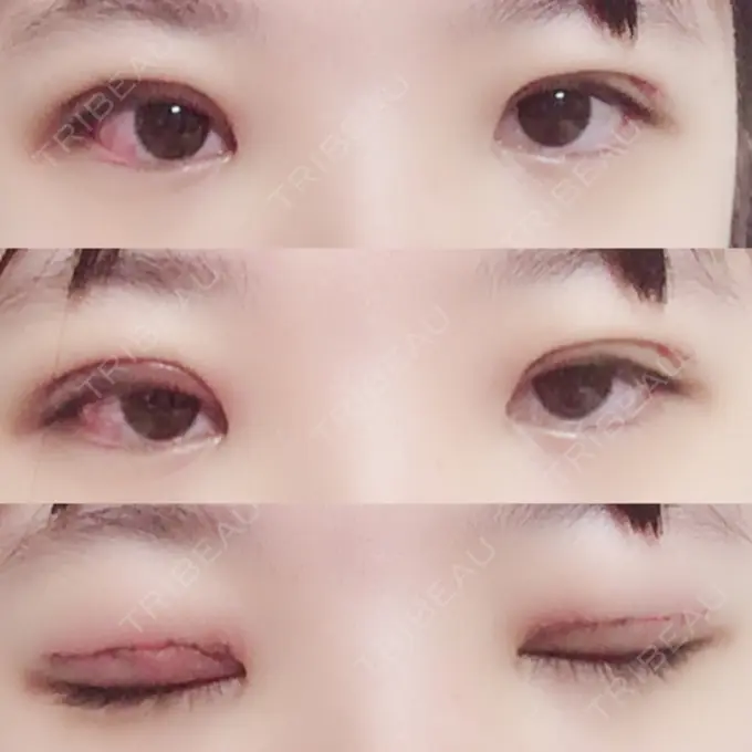 二重切開 / 上まぶたの脂肪取り 聖心美容クリニック 横浜院 DAY 5 メイン用