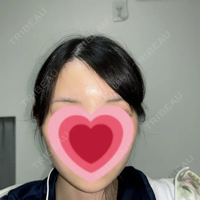 糸リフト / クマ治療 / 下まぶたの脂肪取り / ボトックス（額） Mods Clinic（モッズクリニック） 名古屋院 AFTER メイン用