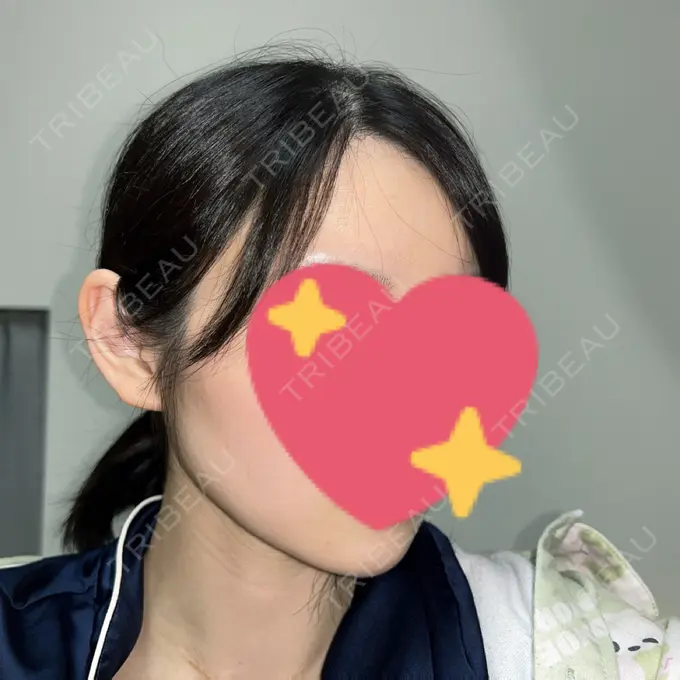 糸リフト / クマ治療 / 下まぶたの脂肪取り / ボトックス（額） Mods Clinic（モッズクリニック） 名古屋院 DAY 153 メイン用