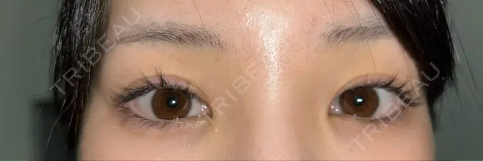 糸リフト / クマ治療 / 下まぶたの脂肪取り / ボトックス（額） Mods Clinic（モッズクリニック） 名古屋院 DAY 153 メイン用