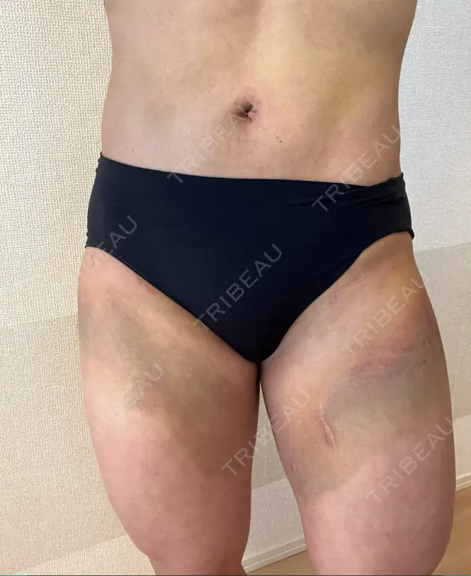 脂肪吸引（お腹） / 脂肪吸引（腰） / 脂肪吸引（背中） WOM CLINIC GINZA （ワム クリニック ギンザ） DAY 9 メイン用