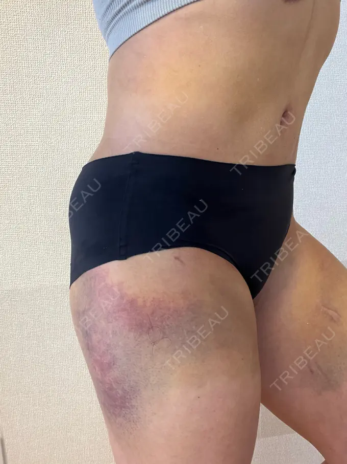 脂肪吸引（お腹） / 脂肪吸引（腰） / 脂肪吸引（背中） WOM CLINIC GINZA （ワム クリニック ギンザ） DAY 9 メイン用