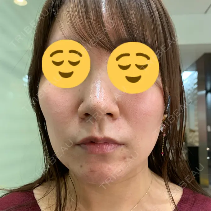 その他（肌） / ルメッカ BIANCA表参道 DAY 0 メイン用