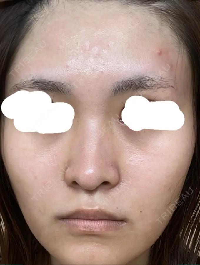 光治療（フォトフェイシャルなど） しらゆりメディカルクリニック （旧しらゆりビューティークリニック） DAY 0 メイン用