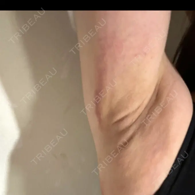 ワキ汗治療（レーザー） Fellez Clinic【フェルズクリニック】 DAY 2 メイン用