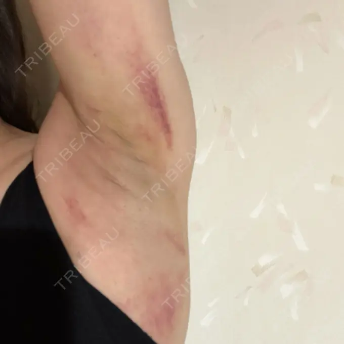 ワキ汗治療（レーザー） Fellez Clinic【フェルズクリニック】 DAY 2 メイン用