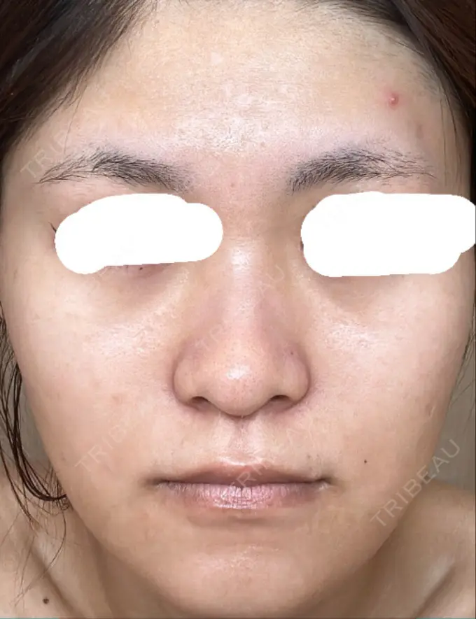 光治療（フォトフェイシャルなど） しらゆりメディカルクリニック （旧しらゆりビューティークリニック） DAY 1 メイン用