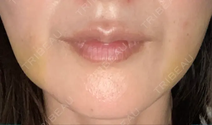 糸リフト / 脂肪吸引（顔） RIVER CLINIC（リバークリニック） DAY 6 メイン用