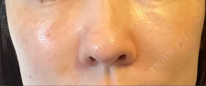 ボトックス（目尻） / ピーリング（ハリ・ツヤ） MYCLINIC 西新宿 AFTER メイン用