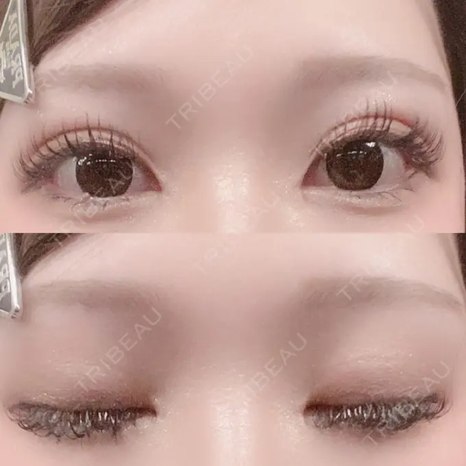 二重埋没 / 目頭切開 Brandnew Beauty Clinic DAY 30 メイン用