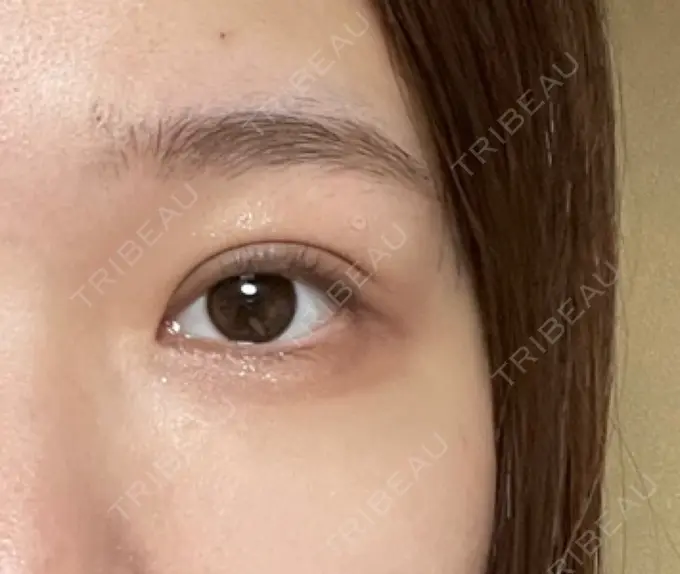 ほくろ・いぼ除去レーザー（肌） リッツ美容外科 大阪院 AFTER メイン用