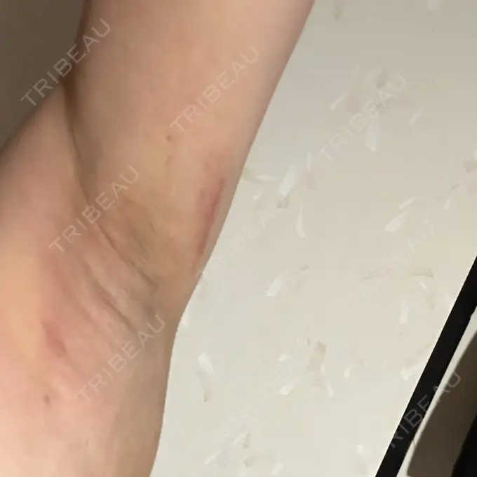 ワキ汗治療（レーザー） Fellez Clinic【フェルズクリニック】 DAY 3 メイン用