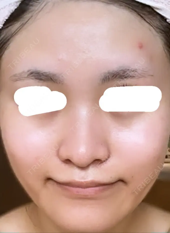 光治療（フォトフェイシャルなど） しらゆりメディカルクリニック （旧しらゆりビューティークリニック） AFTER メイン用