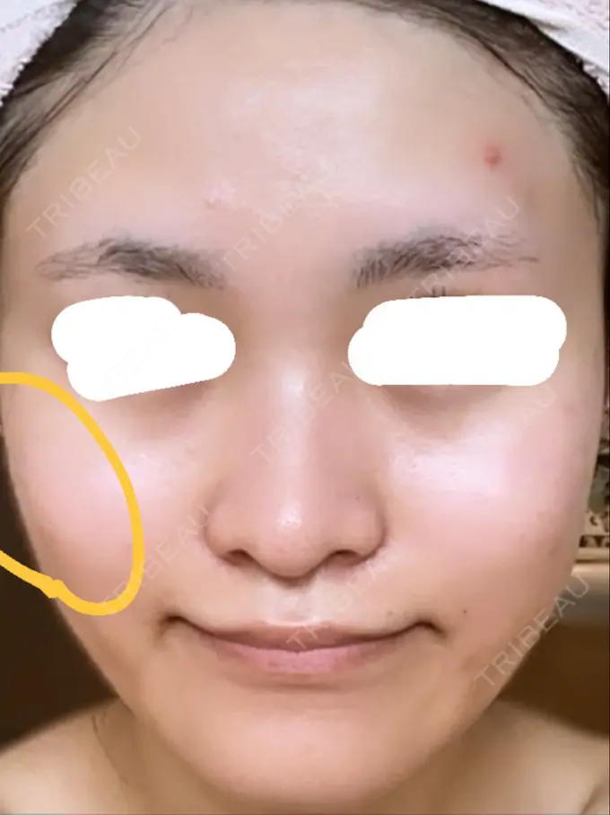 光治療（フォトフェイシャルなど） しらゆりメディカルクリニック （旧しらゆりビューティークリニック） DAY 1 メイン用