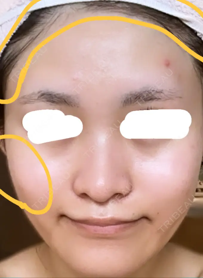 光治療（フォトフェイシャルなど） しらゆりメディカルクリニック （旧しらゆりビューティークリニック） DAY 1 メイン用