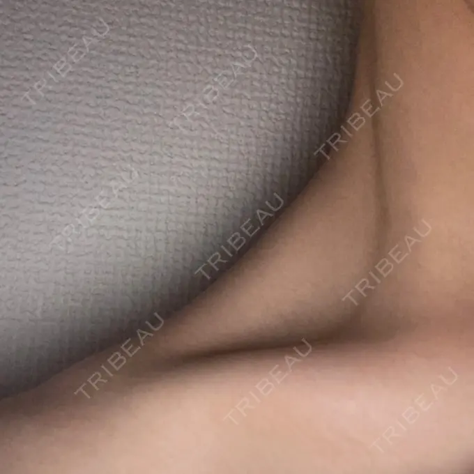 ボトックス（肩） 共立美容外科 梅田院 AFTER メイン用