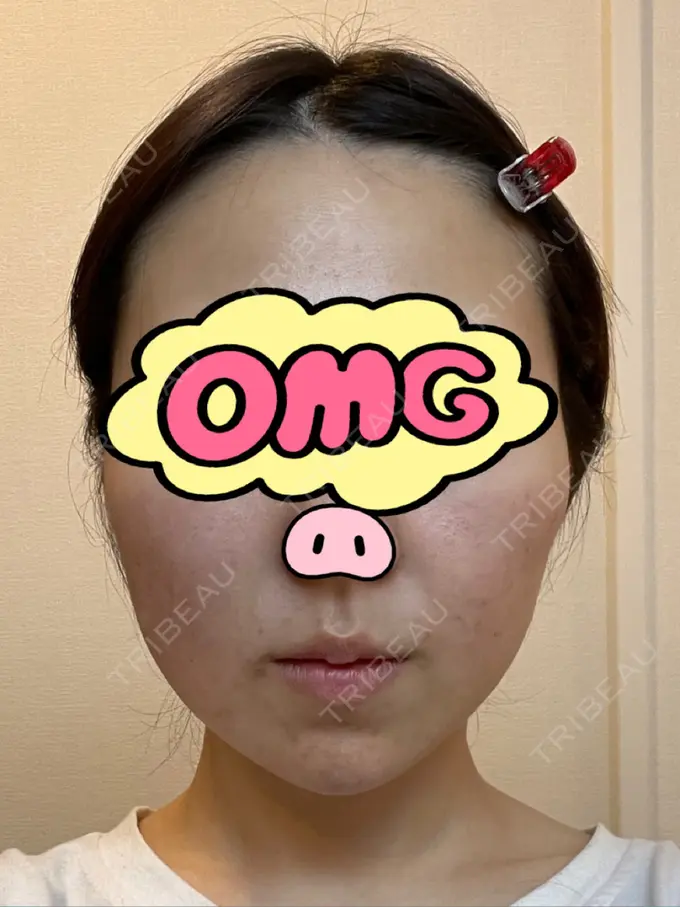 糸リフト / ボトックス（あご） / ヒアルロン酸注入（あご） / ボトックス（エラ・小顔） / ボトックス（口角） / ヒアルロン酸注入（頬） GRACIA clinic 【グラシアクリニック】 DAY 6 メイン用