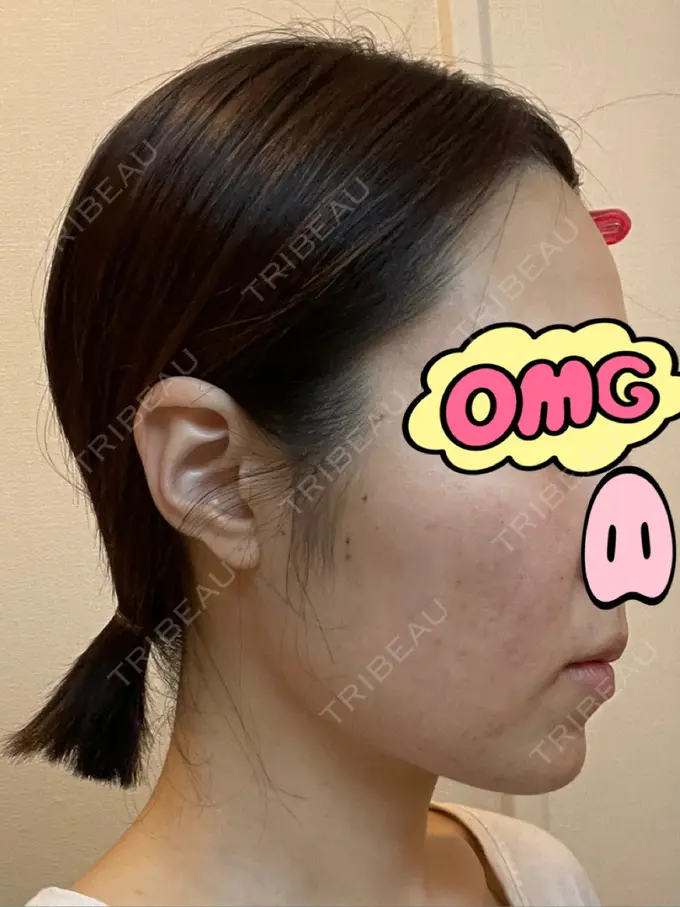 糸リフト / ボトックス（あご） / ヒアルロン酸注入（あご） / ボトックス（エラ・小顔） / ボトックス（口角） / ヒアルロン酸注入（頬） GRACIA clinic 【グラシアクリニック】 DAY 6 メイン用