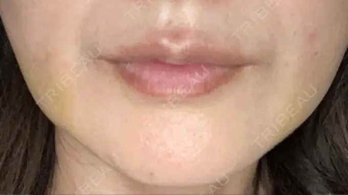 糸リフト / 脂肪吸引（顔） RIVER CLINIC（リバークリニック） DAY 8 メイン用