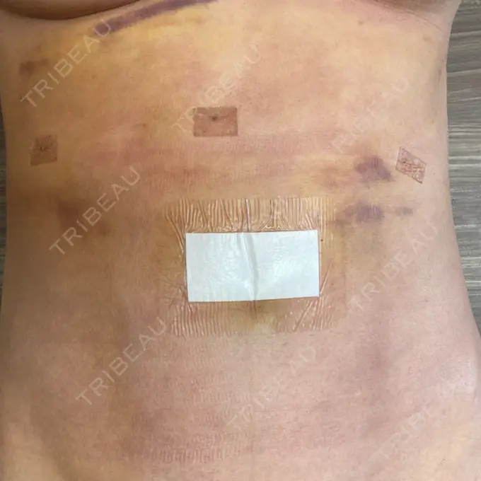 脂肪吸引（二の腕） / 脂肪吸引（お腹） / 豊胸（脂肪注入） / 脂肪吸引（肩） Casa de GRACIA GINZA 【カーサデグラシアギンザ】 DAY 189 メイン用